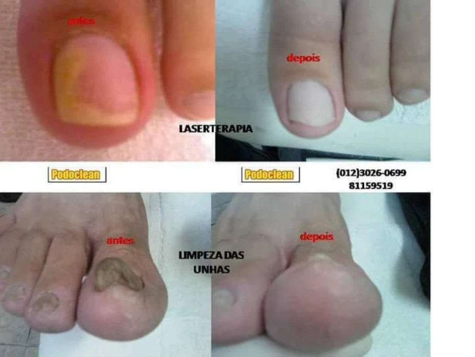Foto 2:  — Podoclean - Podologia  e Laserterapia